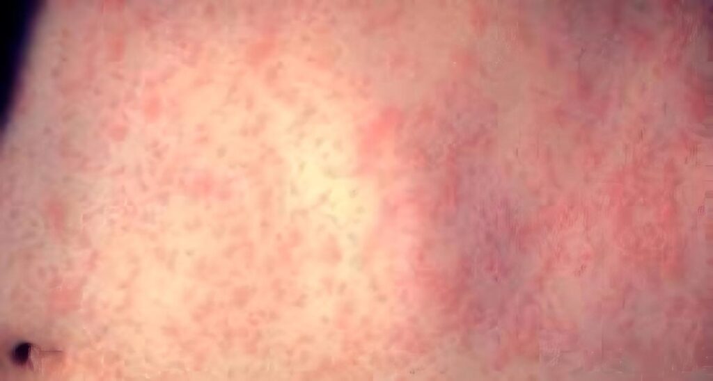 Analgésicos para Cáncer