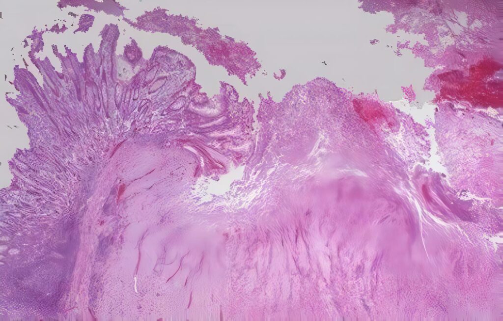 Aterosclerosis por Helicobacter