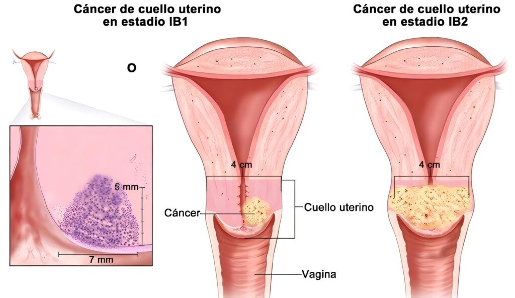 Cáncer de Cuello Uterino