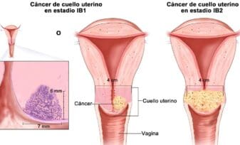 Cáncer de Cuello Uterino