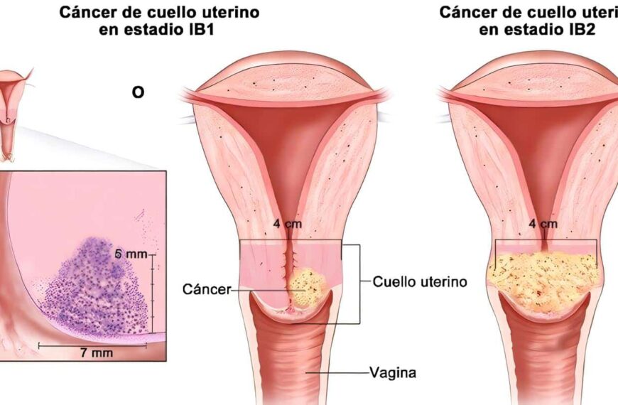 Cáncer de Cuello Uterino