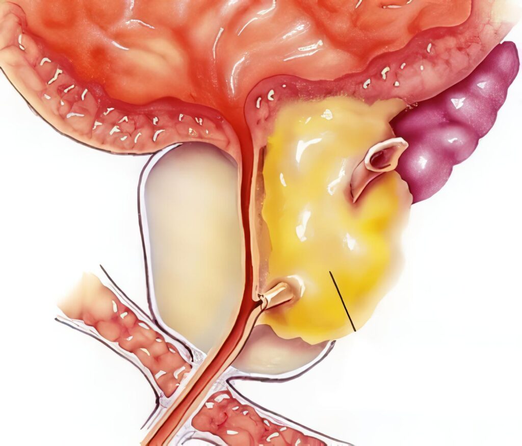 Genes Relacionados con el Cáncer de Próstata Agresivo