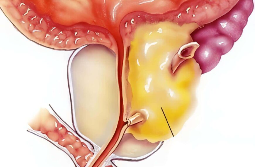 Genes Relacionados con el Cáncer de Próstata Agresivo