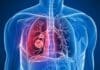 Cáncer de Pulmón
