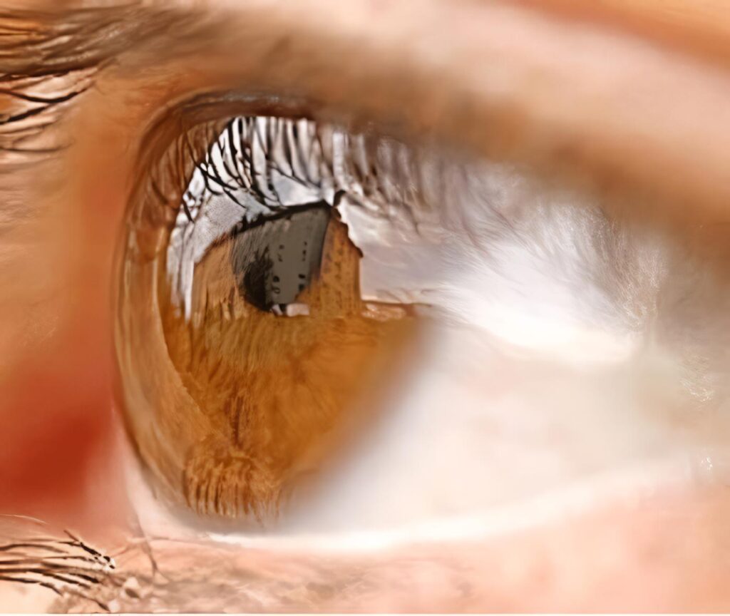 Perlas. Los estrógenos posmenopáusicos pueden disminuir ligeramente el riesgo de glaucoma 