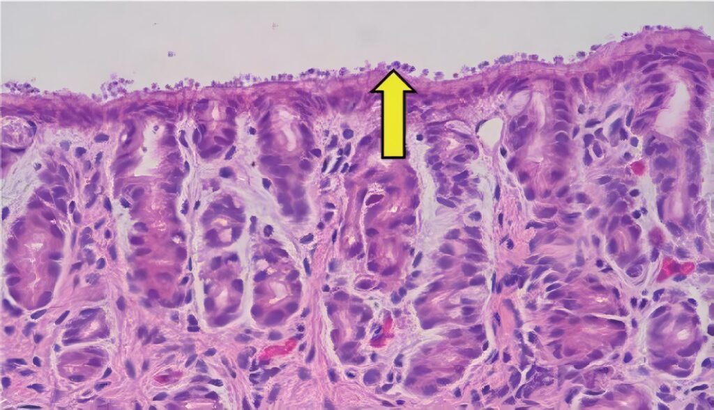 Criptosporidiosis en Niños con Cáncer