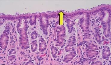 Criptosporidiosis en Niños con Cáncer