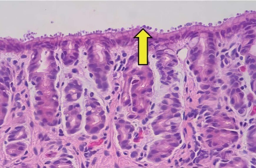 Criptosporidiosis en Niños con Cáncer