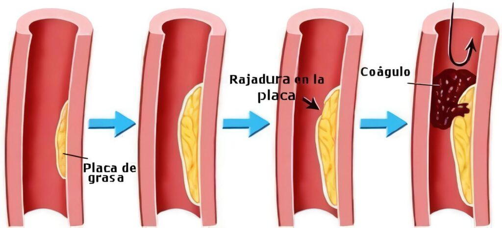 Definición de Infarto