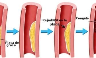 Definición de Infarto