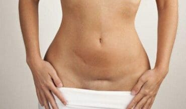 Endometriosis Riesgo de Tres Cánceres de Ovario