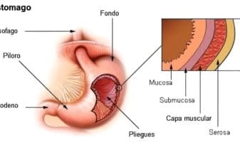 Endoscópica de Cáncer Gástrico