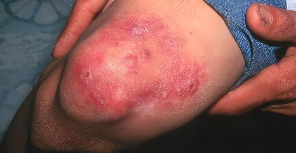 Subsidio de Pacientes con Enfermedad de Hansen