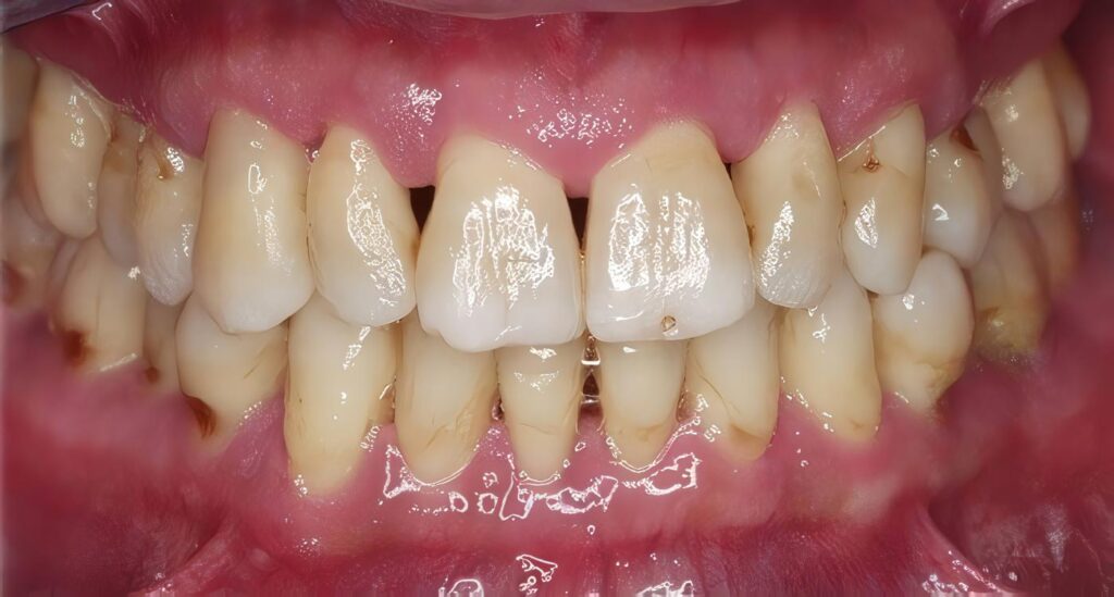Osteoporosis y Enfermedad Periodontal
