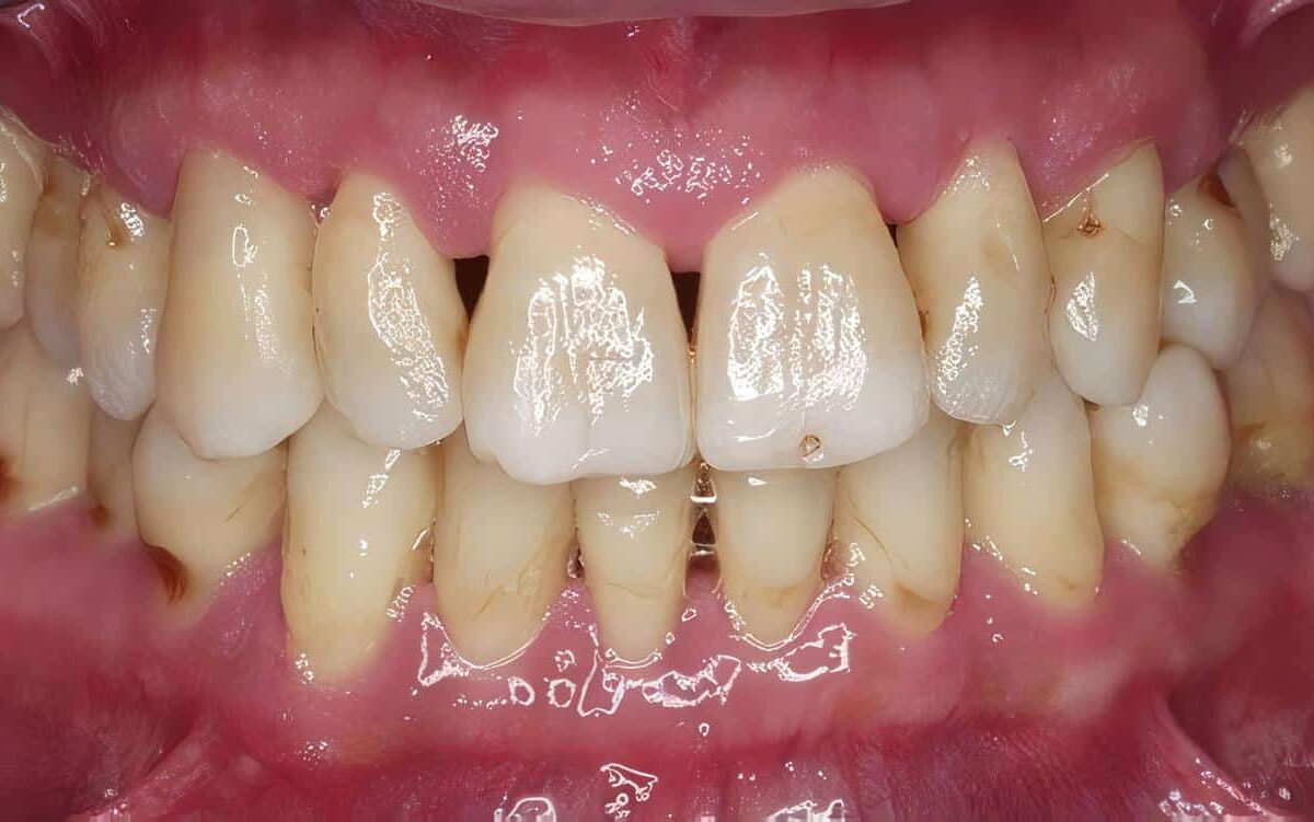Enfermedad Periodontal