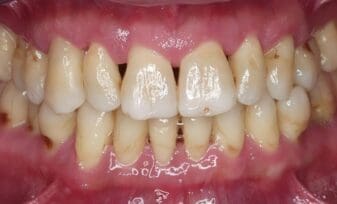 Enfermedad Periodontal