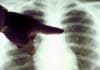 Enfermedad Pulmonar puede ser Genética