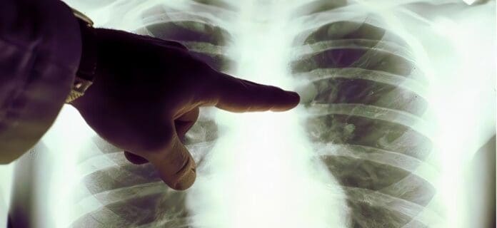 Enfermedad Pulmonar puede ser Genética