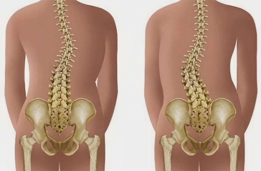 Tratamiento para la Escoliosis Podría Reducir las Cirugías