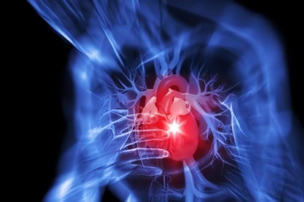 Eyección Post-Infarto