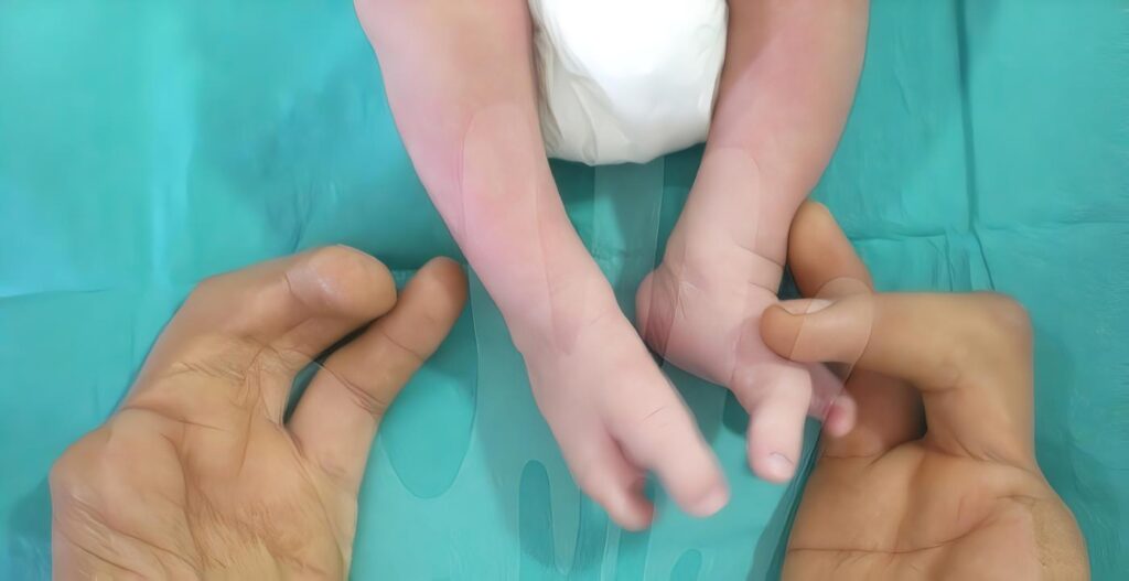 Hiperostosis/Ostesclerosis