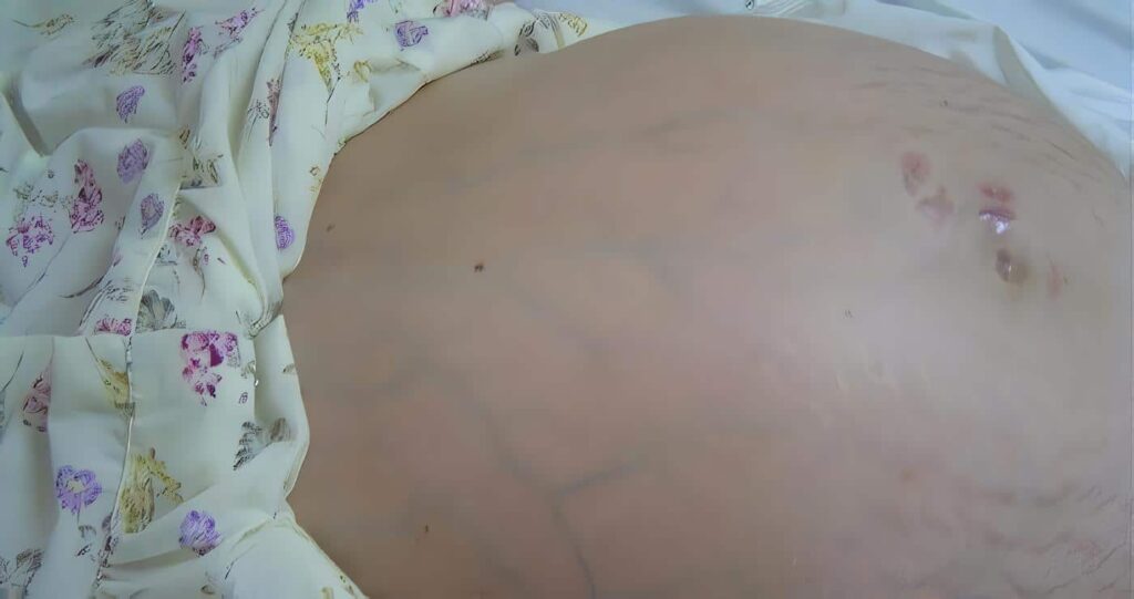 Hipertensión portal en niños