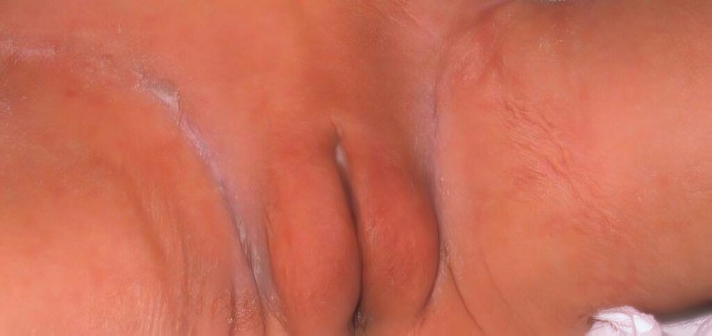 Hipogonadismo Hipergonadotrófico