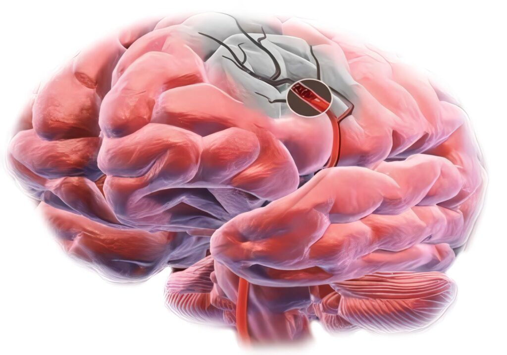 Accidentes Cerebro Vasculares