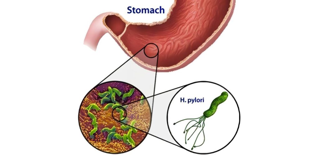 Infección por Helicobacter Pyloti