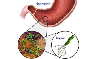 Infección por Helicobacter Pyloti