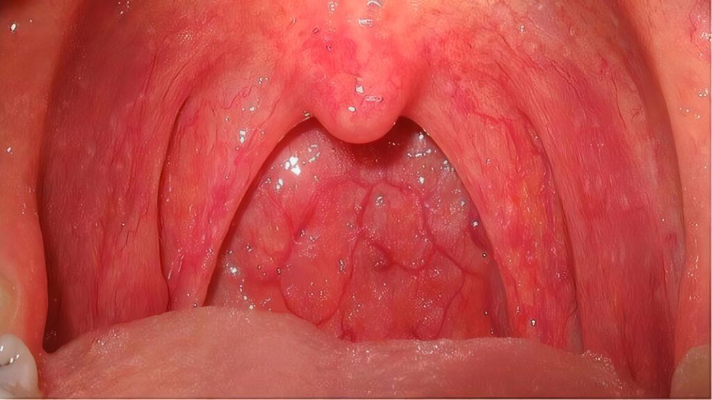 Infecciones de Cabeza y Cuello