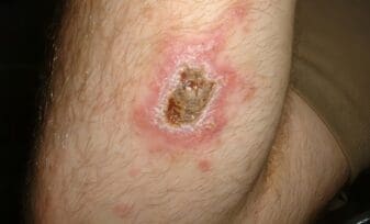 Leishmaniasis