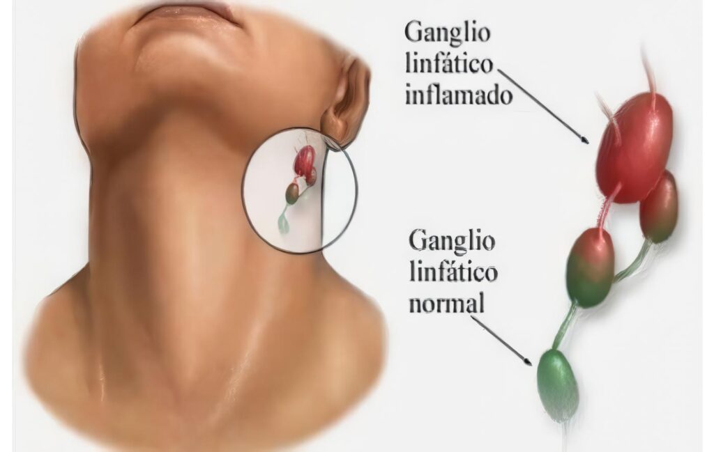 Linfadenopatías Malignas