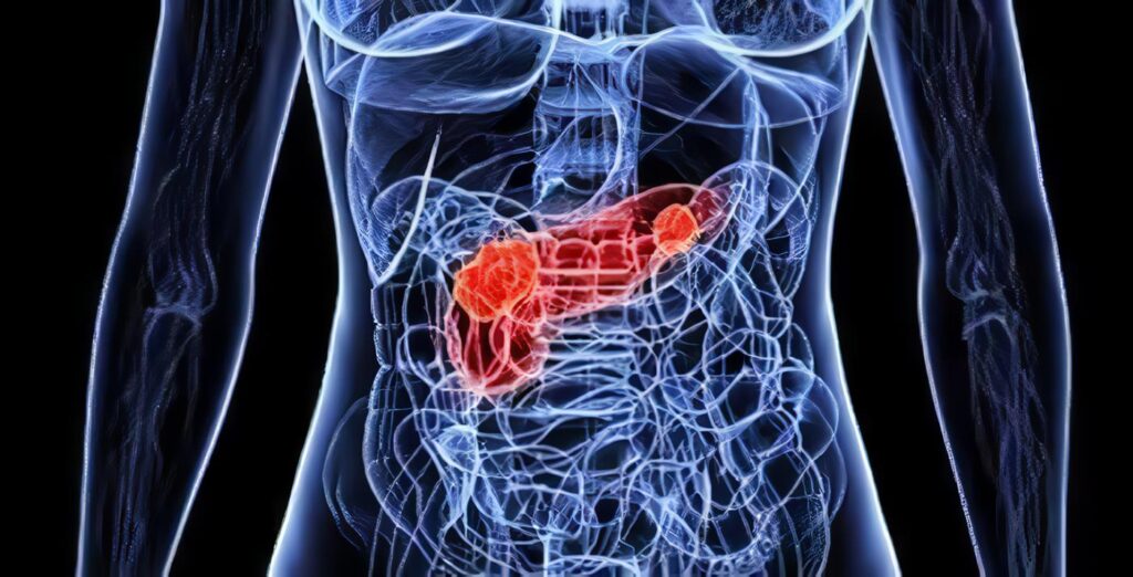 Localización de los Insulinomas