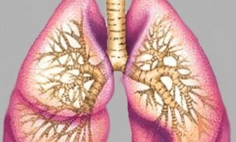 Relacionan Mala Función Pulmonar con Insuficiencia Cardiaca