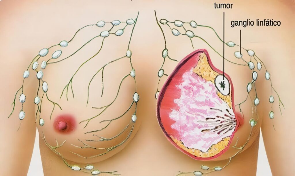 Marcadores de Cáncer de Seno