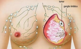 Marcadores de Cáncer de Seno