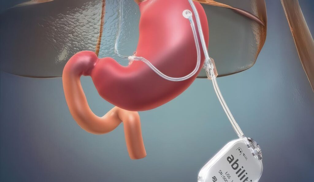 Marcapasos Gástrico