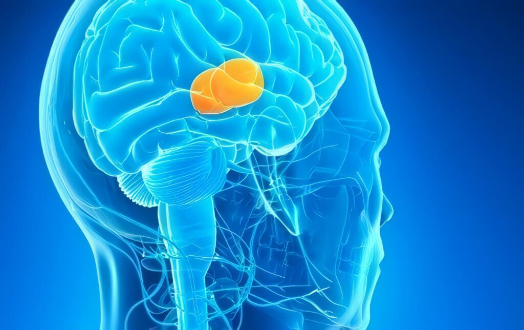 Melanoma Cerebral Sangrante