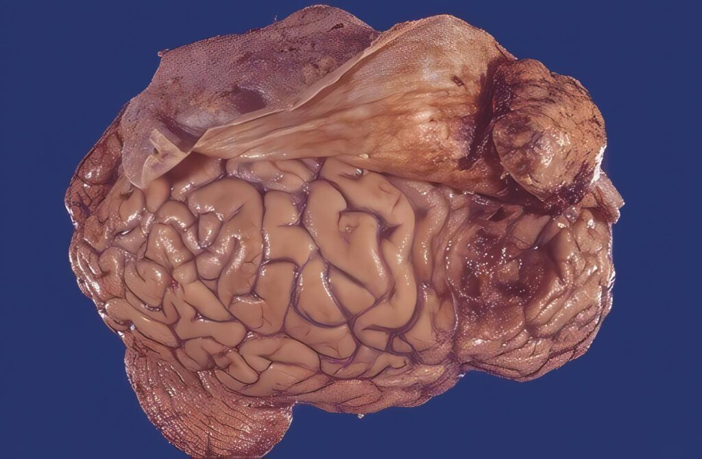 Meningioma