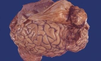 Meningioma