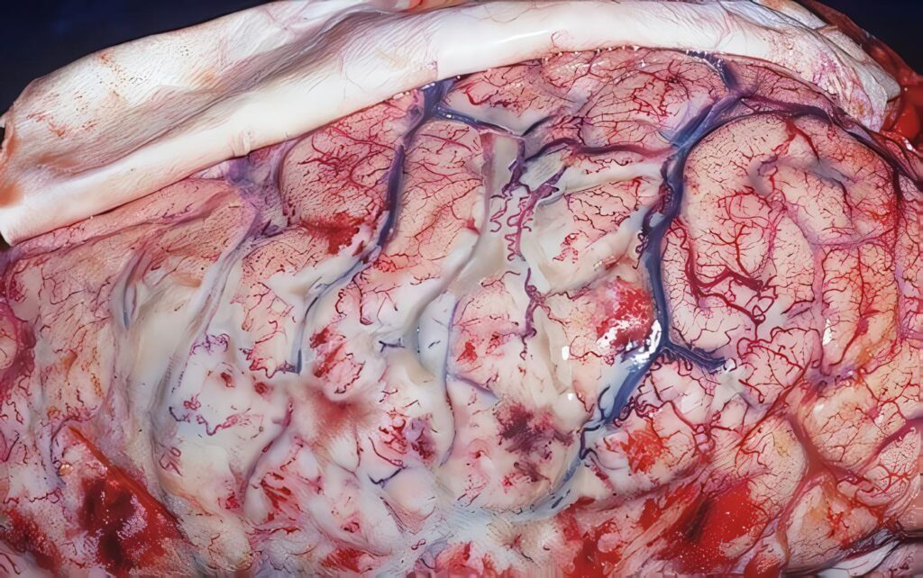 Meningitis Aguda