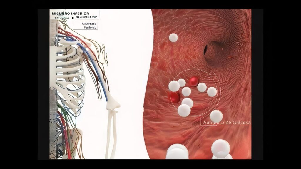 Mono Neuropatía Post-Traumática
