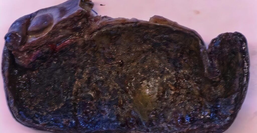 Necrosis Vesicular