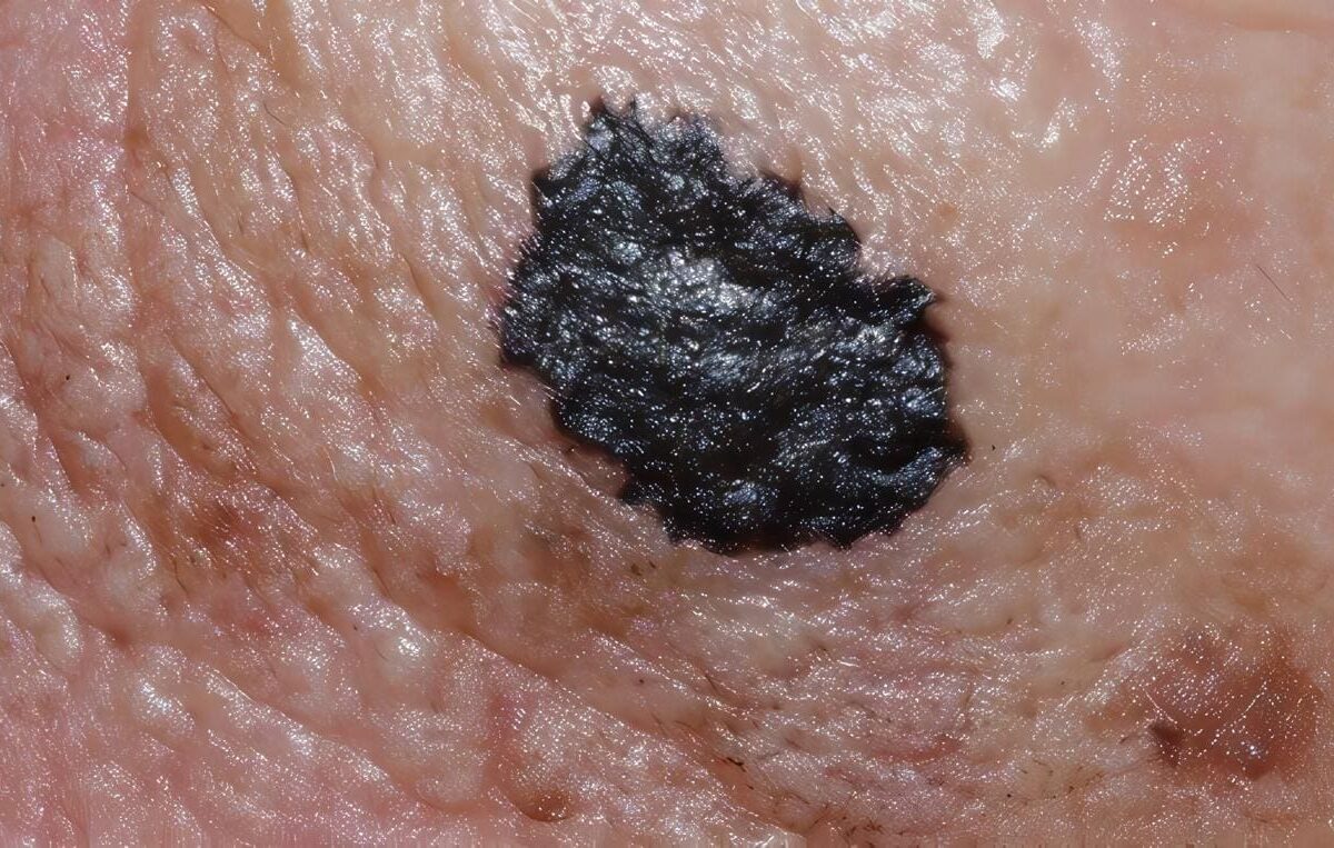 Melanoma Maligno