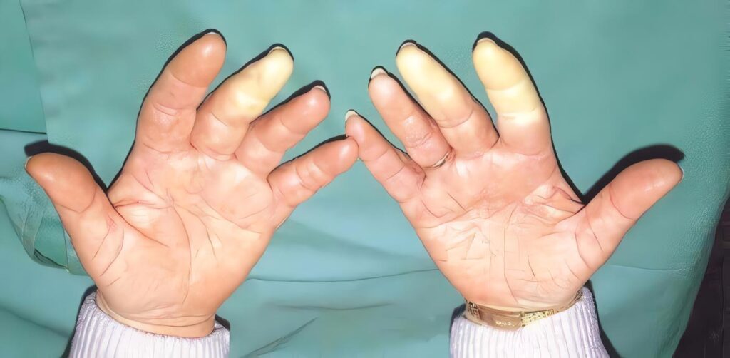 Palidez Palmar como Signo de Anemia
