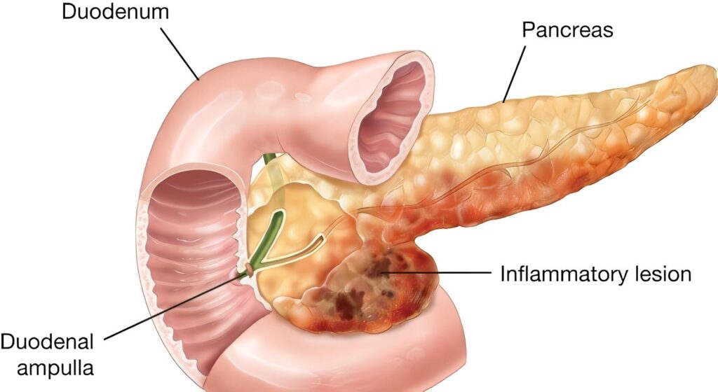 Pancreatitis Aguda