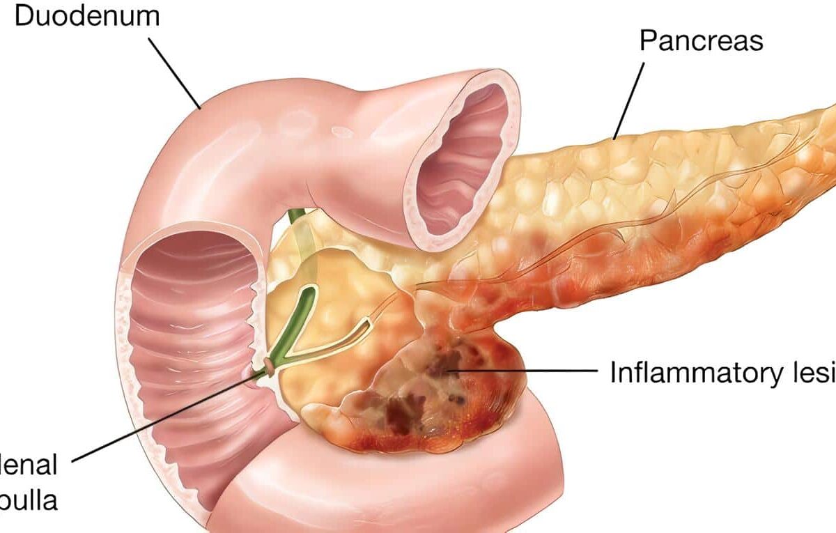 Pancreatitis