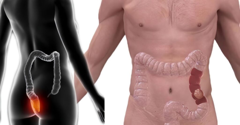 Detectar Perforación Intestinal