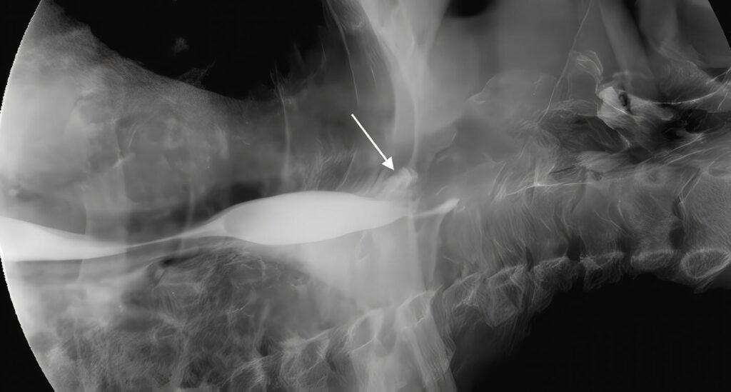 Perforaciones Esofágicas